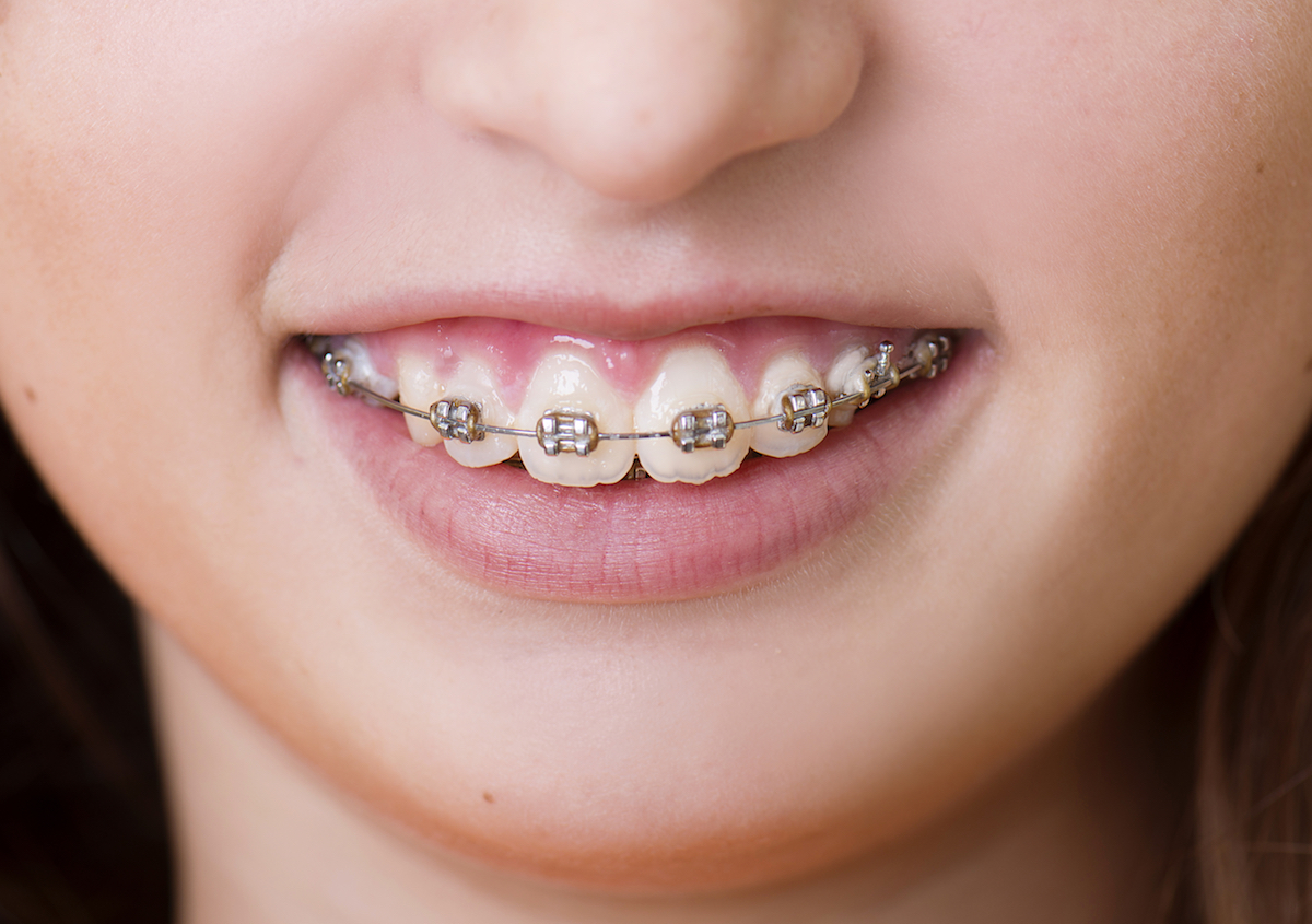 How do braces work? Gray Dental Group Edmond, OK 73034