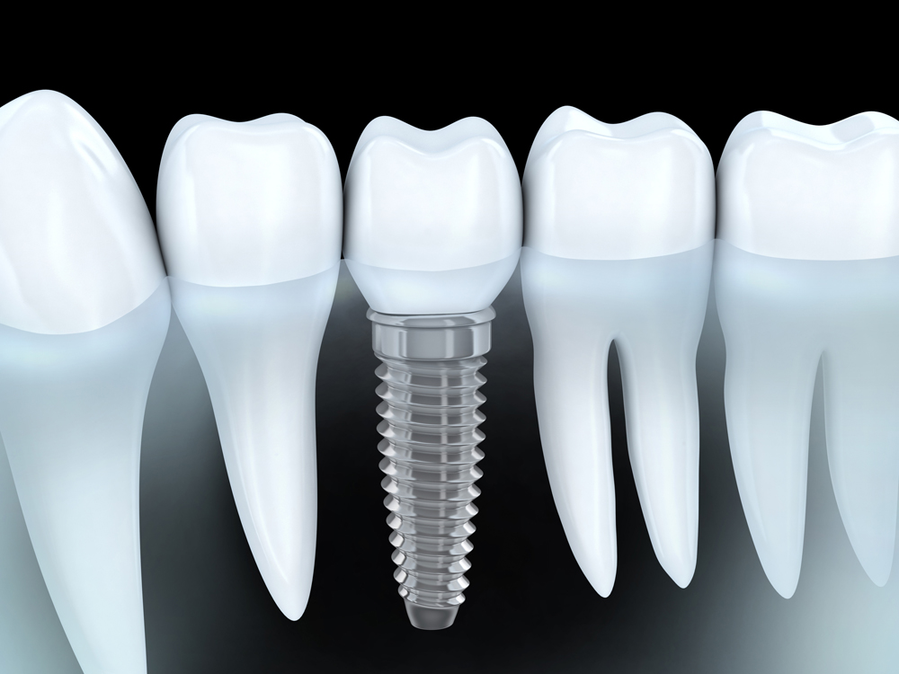The basics of dental implants Gray Dental Group Edmond, OK 73034