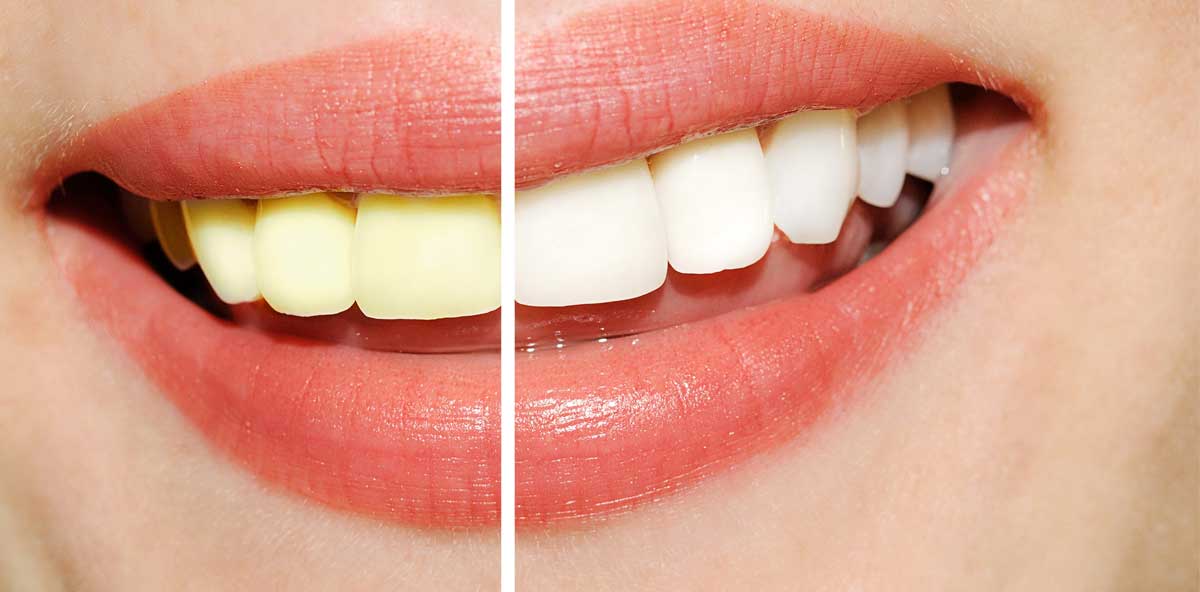 Can dentists whiten yellow teeth? Gray Dental Group Edmond, OK 73034