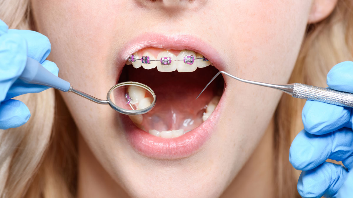 How do dentists put on braces? Gray Dental Group Edmond, OK 73034