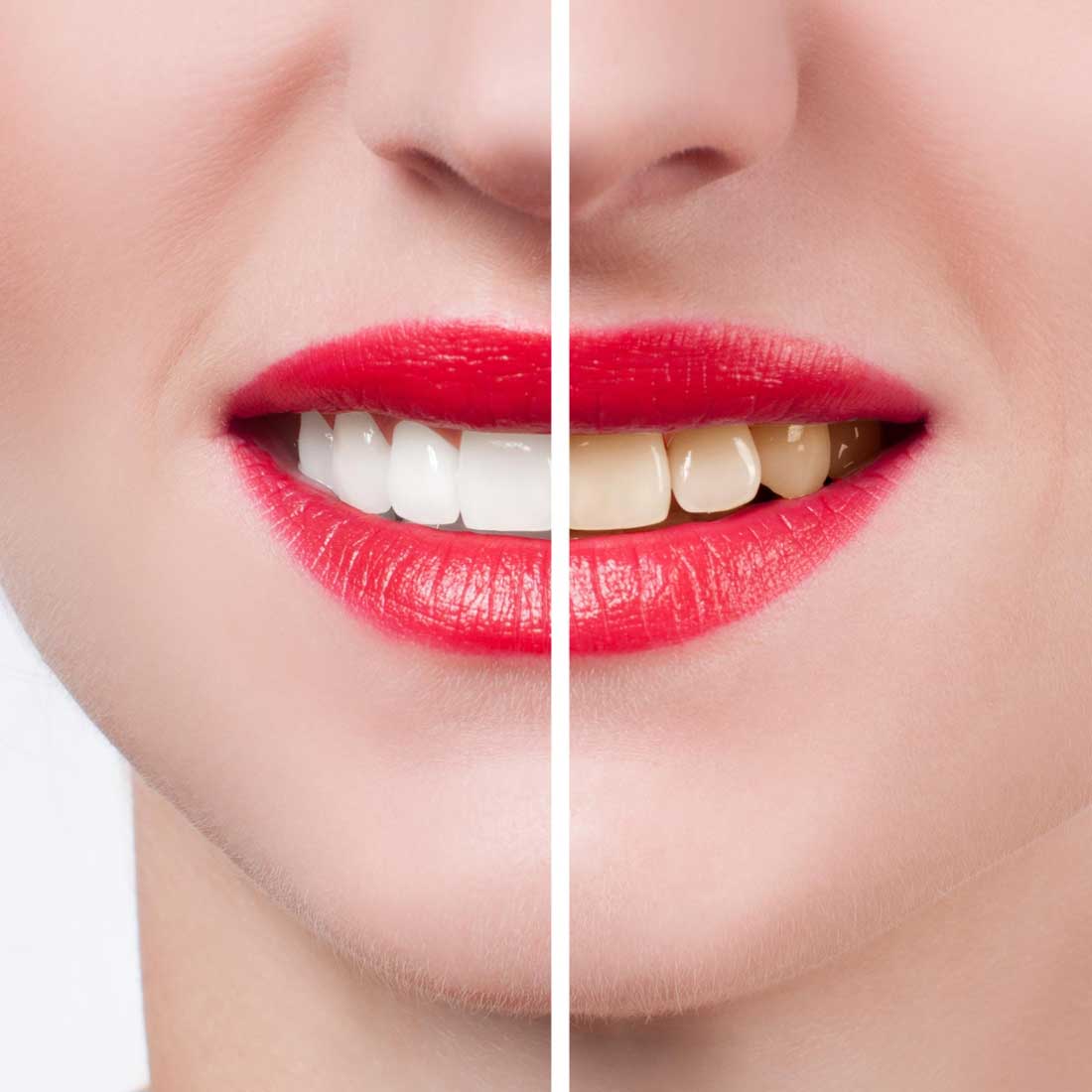 Can dental crowns be whitened? Gray Dental Group Edmond, OK 73034