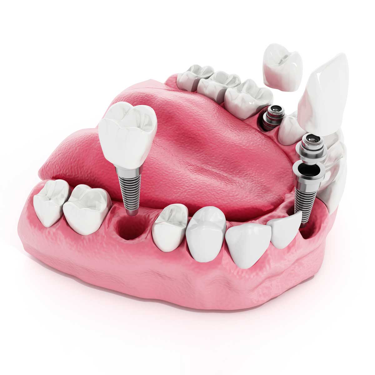 Can dental implants decay? Gray Dental Group Edmond, OK 73034