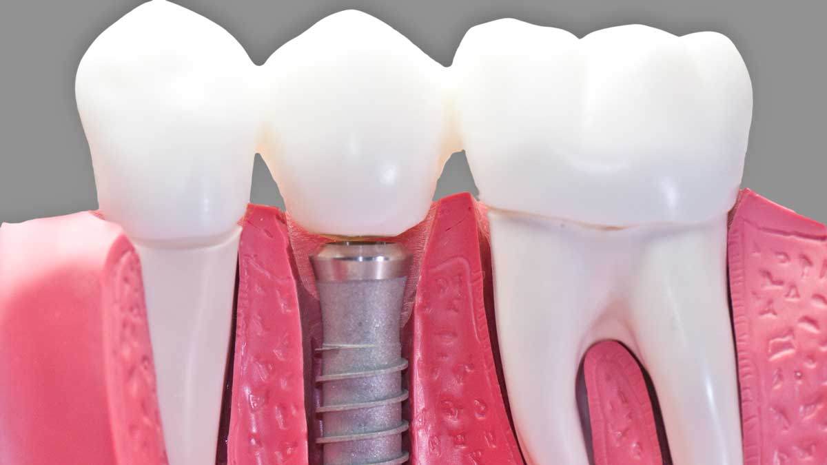 Dental Implants in Edmond