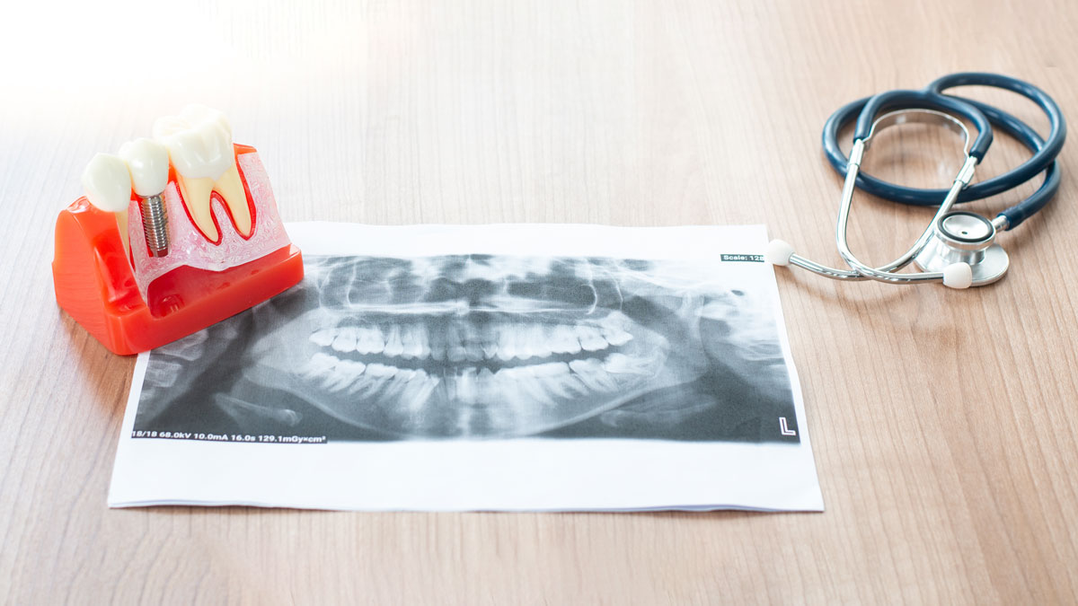 dental implants be done in one day