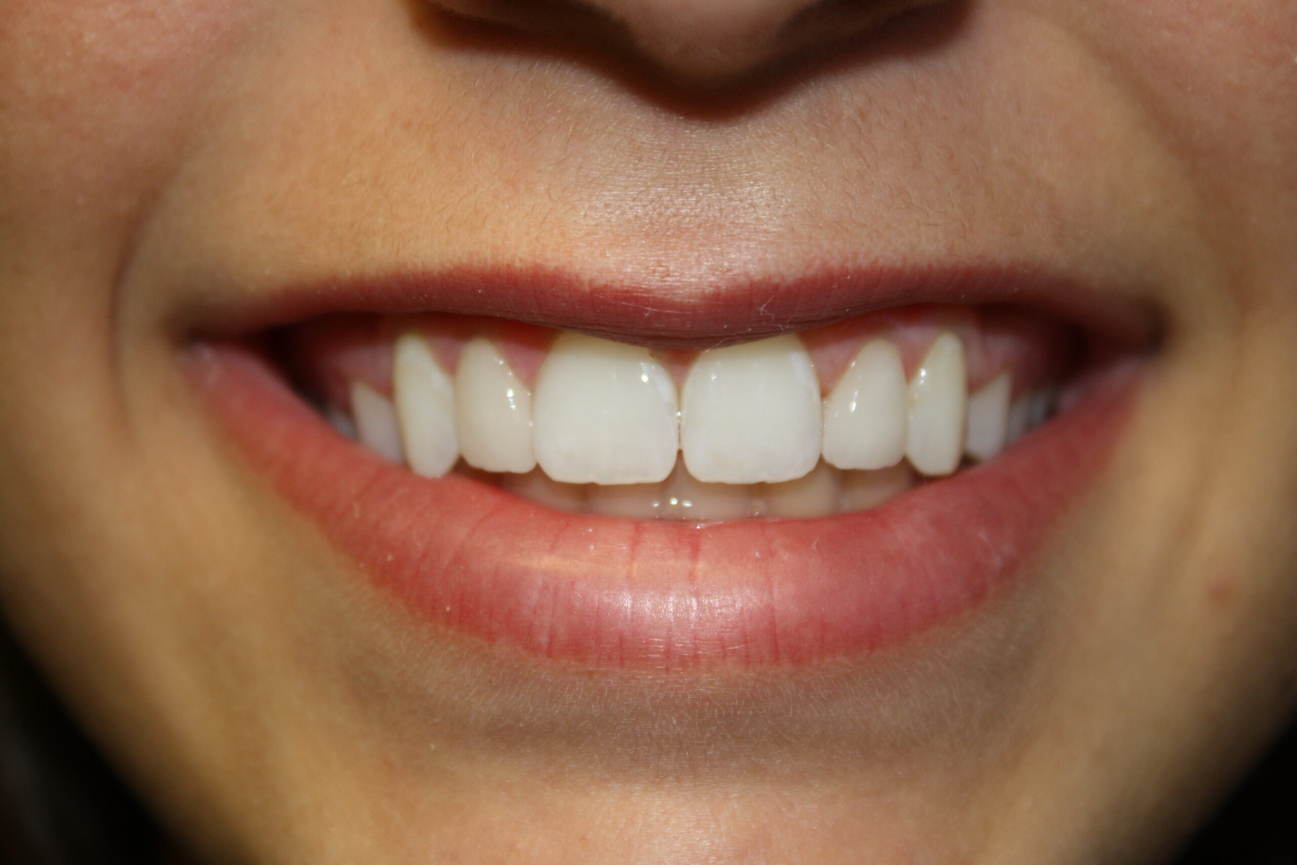 CosmeticBondingAfter3