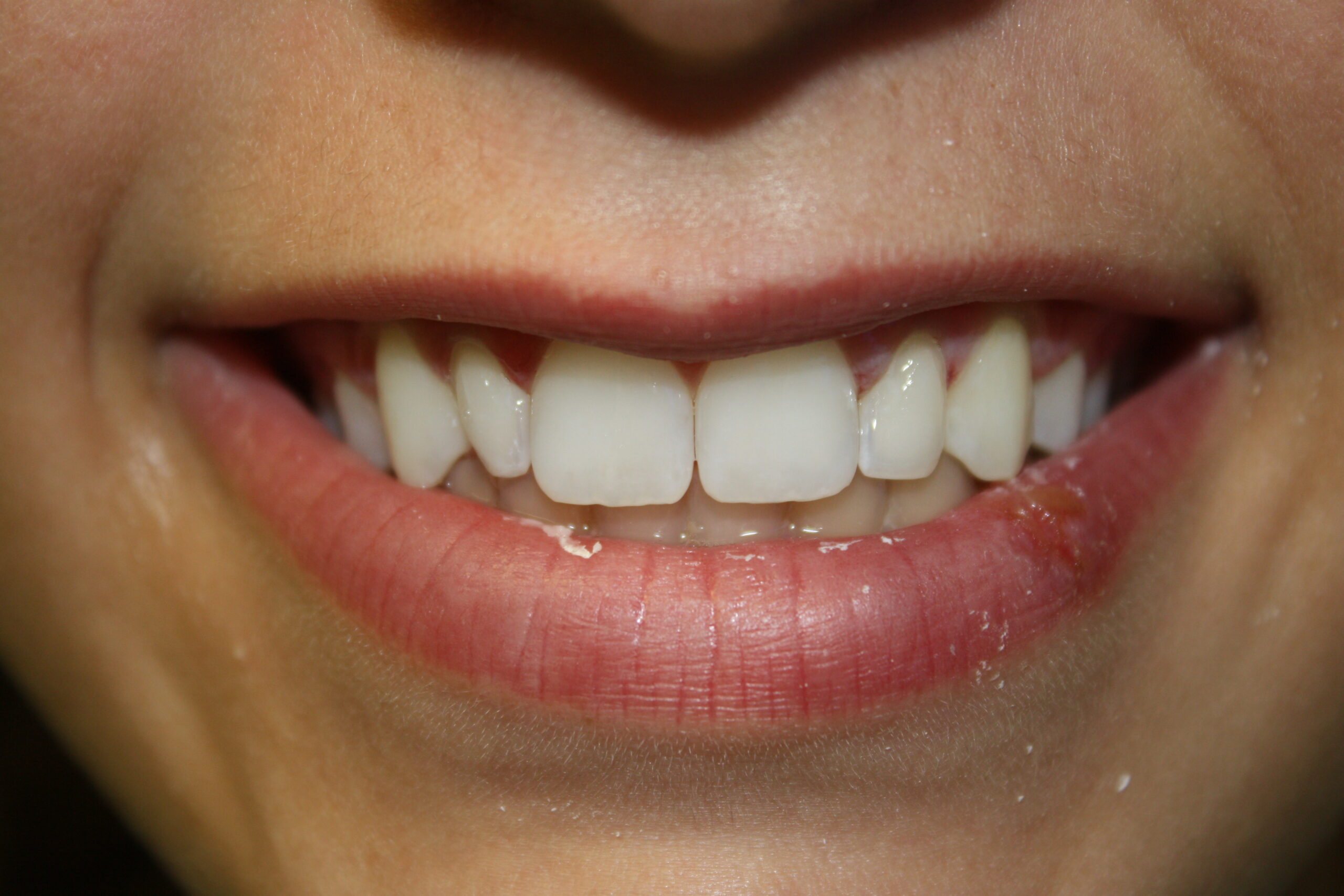 CosmeticBondingBefore3