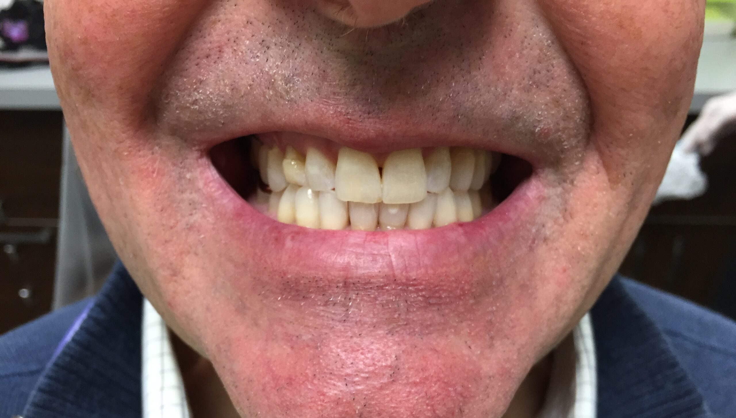 CrownsAndAlignersBefore2