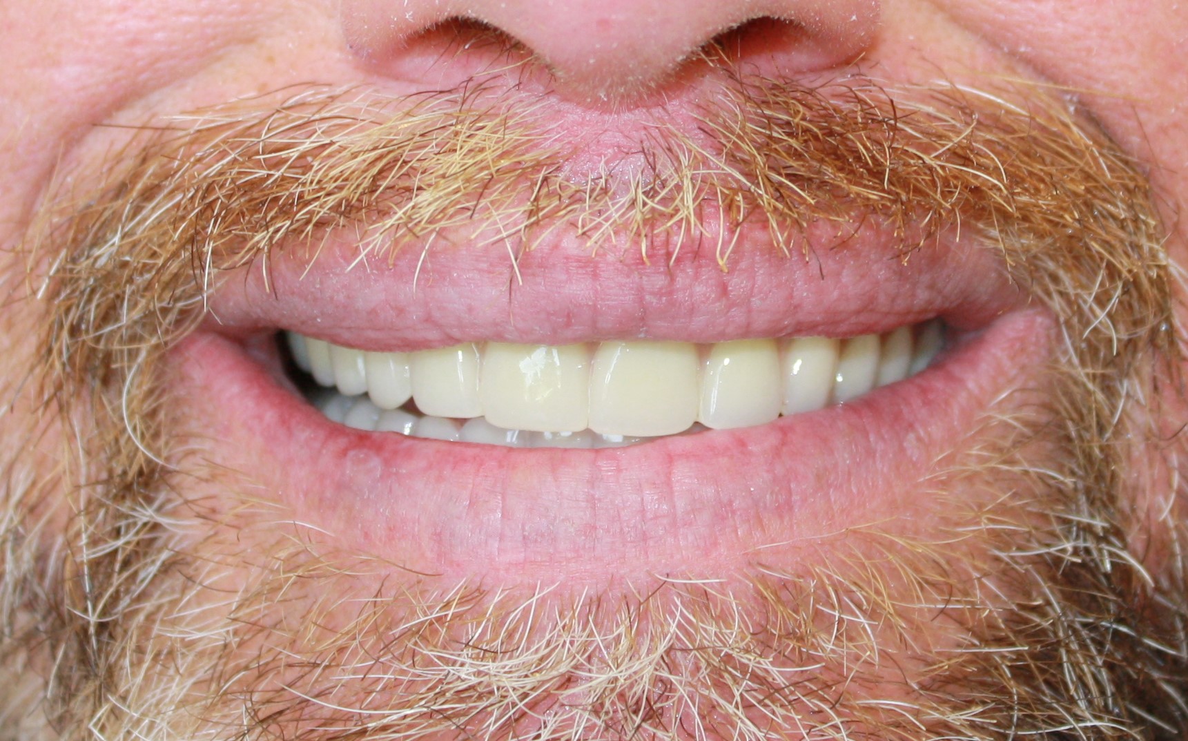 ImplantDentureAfter1