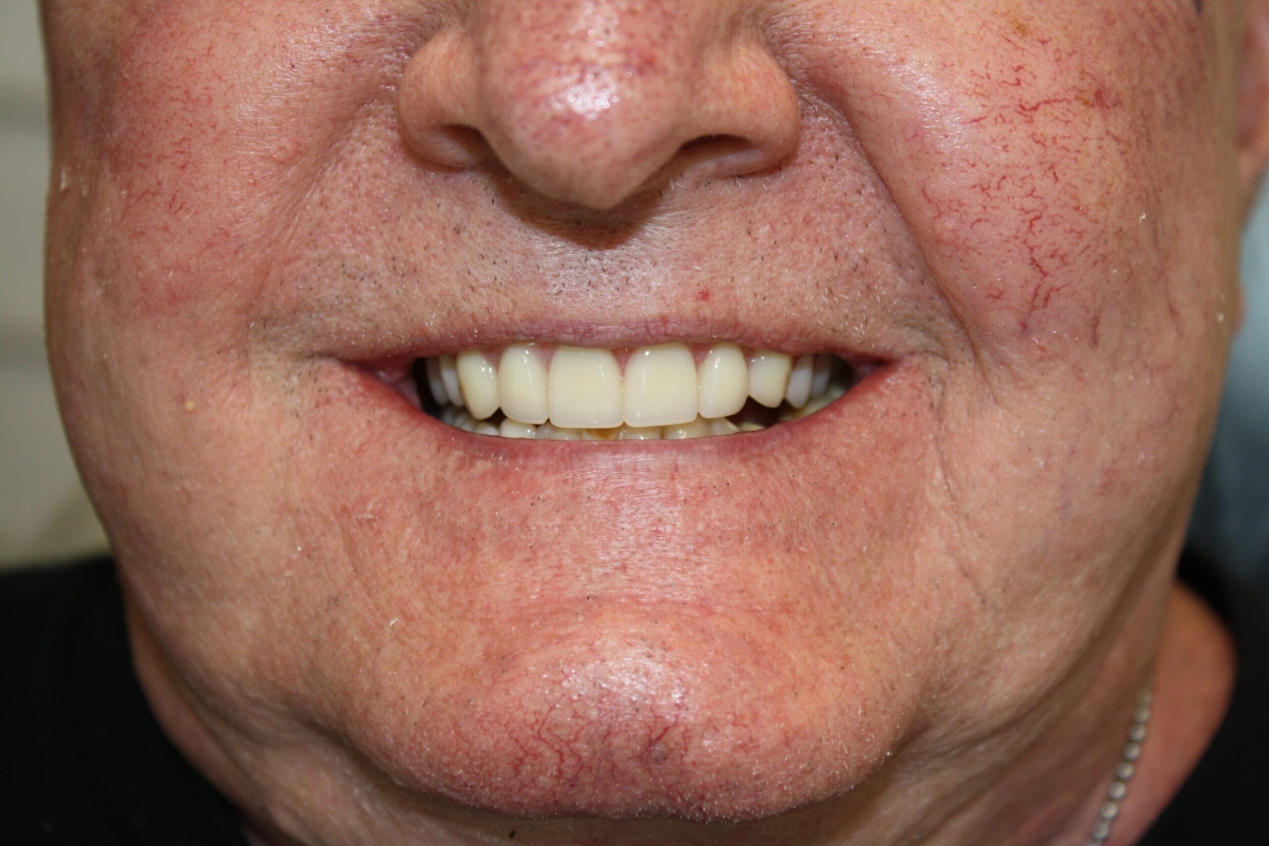 ImplantDentureAfter2