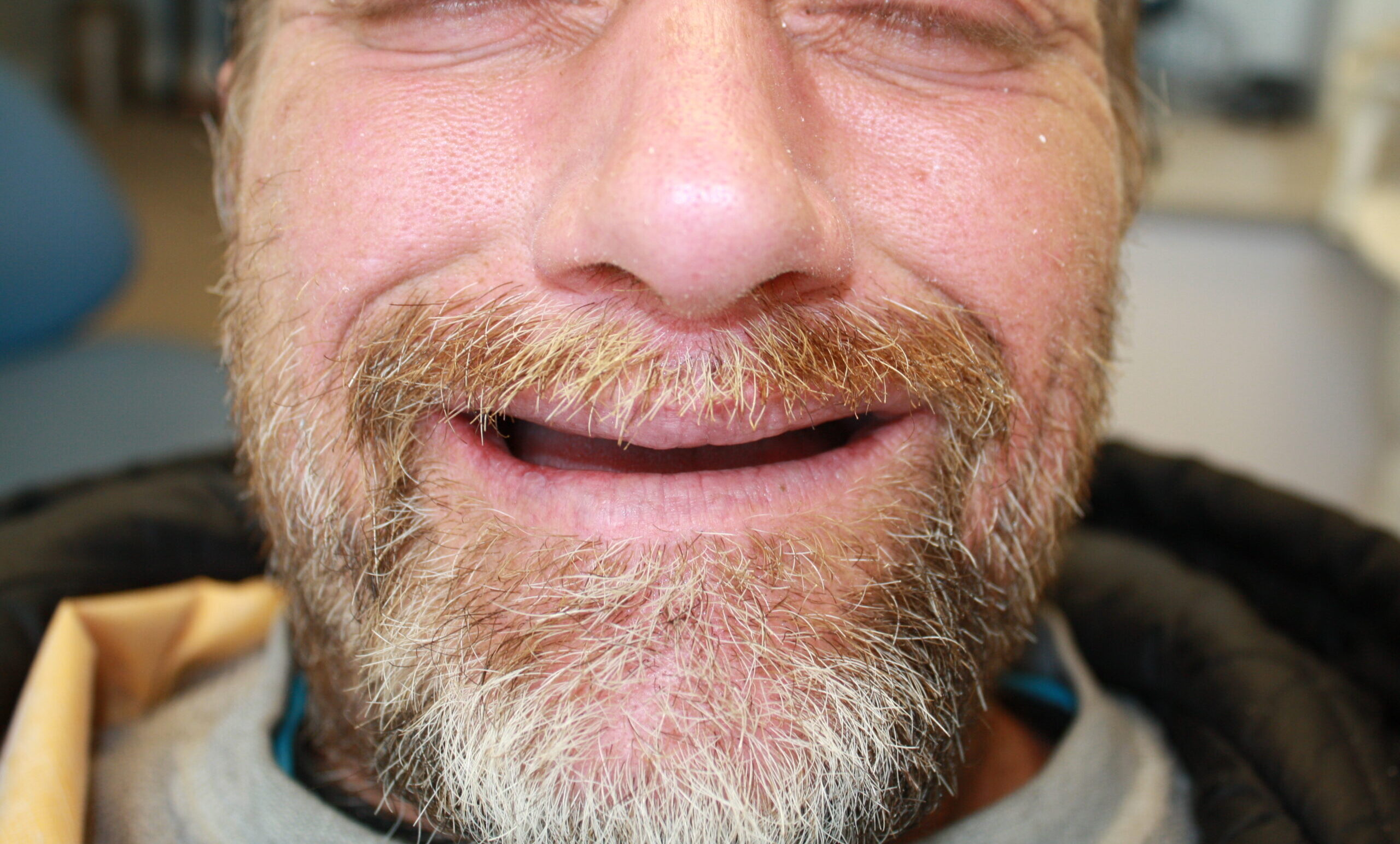 ImplantDentureBefore1