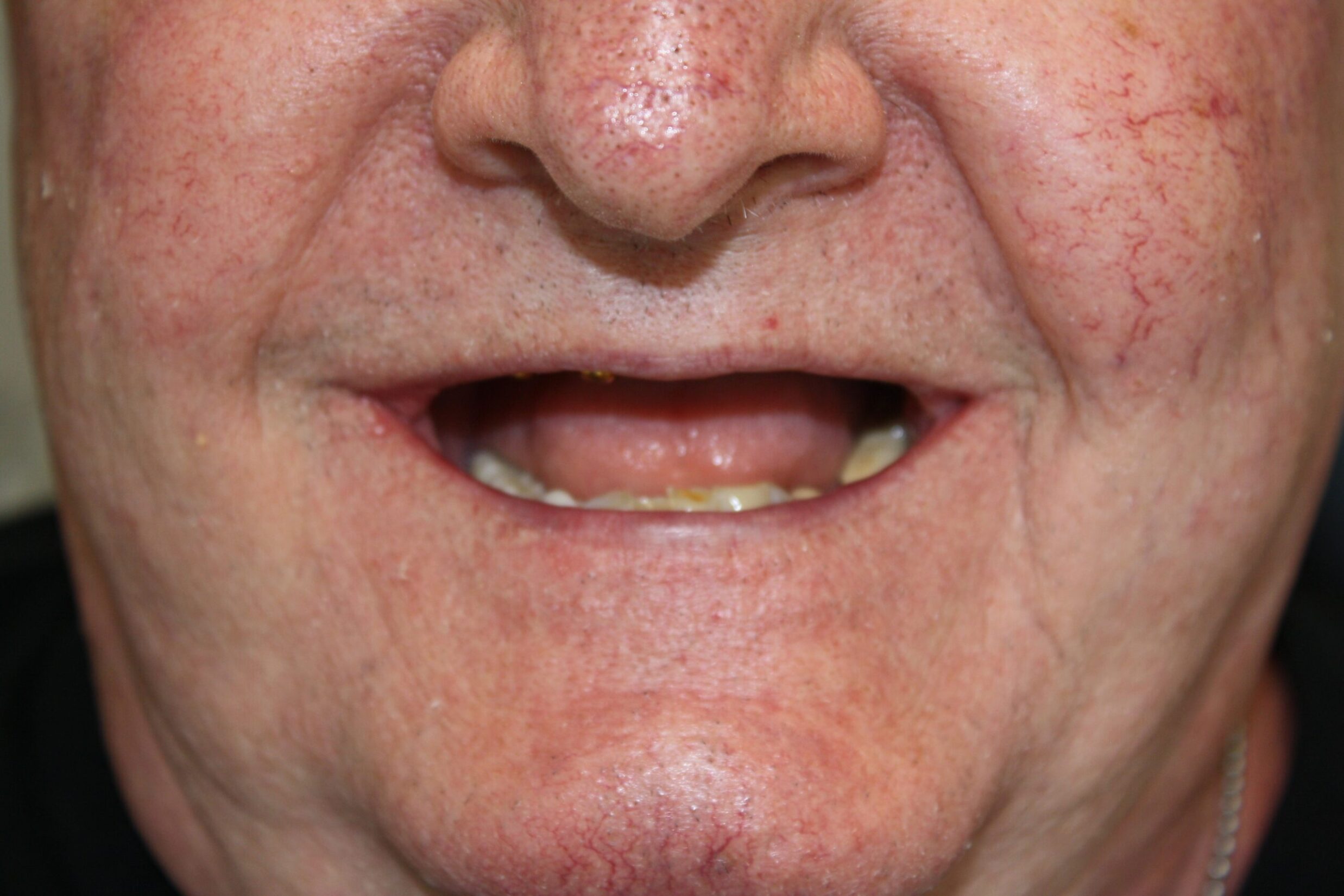 ImplantDentureBefore2